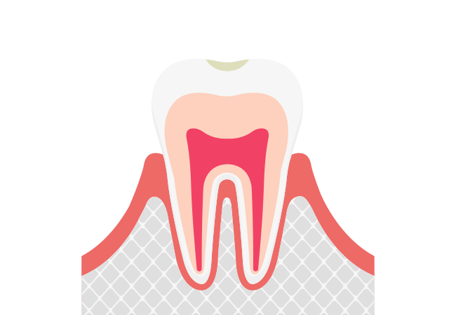 ごく初期のむし歯【CO】