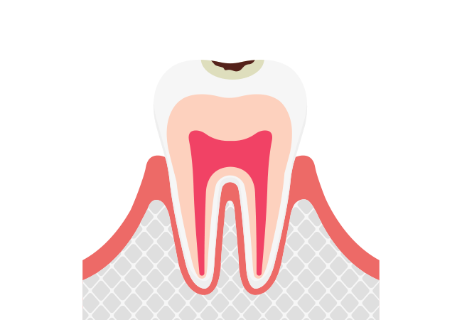 エナメル質に小さな穴が空いたむし歯【C1】