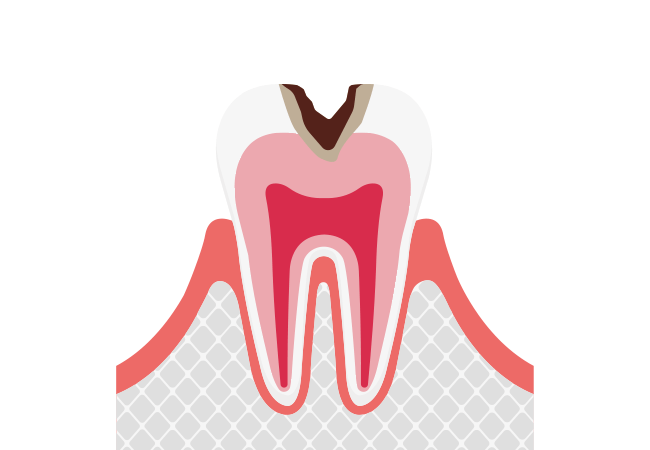歯の内部（象牙質）まで進行したむし歯【C2】