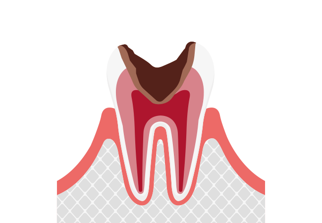 神経まで進行したむし歯【C3】