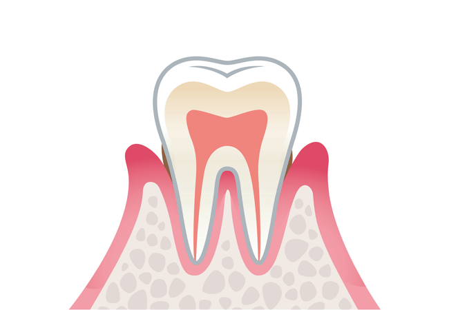 軽度歯周病