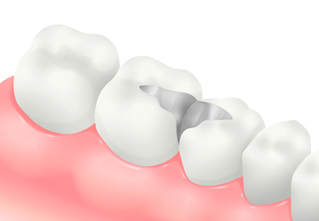 メタルインレー（銀色の金属素材）