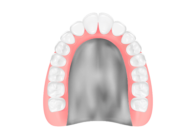 コバルトクロム床義歯